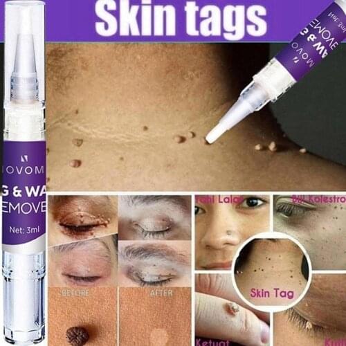 1Pc Skin Tag Remover Anti Foot Corn Removal Warts Papillomas Rapidly Removes Moles Against Mole & Genital Wart Skin Care Tools