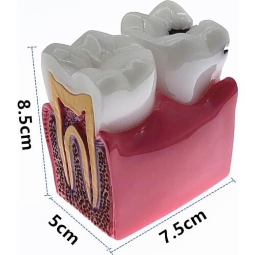 1 Piece 4:1/6:1 Size Dental Caries Removable Teeth Tooth Model Learn Study Model