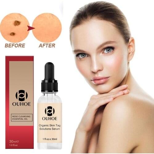 Tags Solutions Serum 30ml No Trace Painle Skin Tag Remover Serum Mole Removal Cream Painless Face Wart Mole Freckle