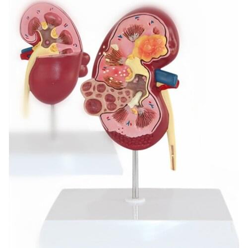 Life Size Human Kidney Lesion Diseased Model Anatomical Anatomy Pathological Stone Organ Teaching Learning Supplies