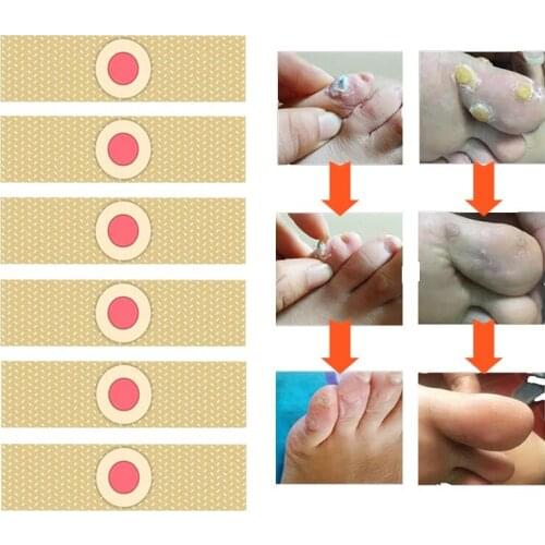 30pcs Foot Care Medical Plaster Feet Medical Corn Remover Warts Thorn Patch Callus Removal Sticker Soften Skin Cutin