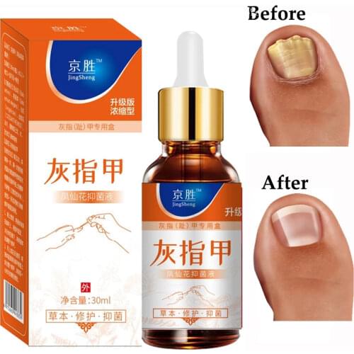 Onychomycosis Nail Repair Promote Regrow Nail Care Nail Essence Anti Infection Paronychia Leuconychia Toe Nails Removal Gel
