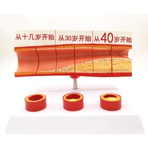 Human Age Vascular Obstruction Medical Model Clear Texture Easy to Carry