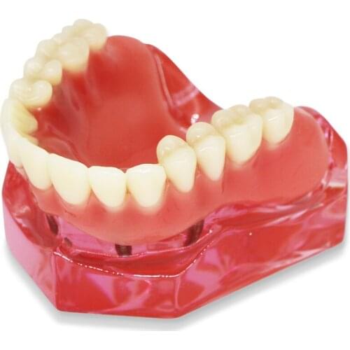 Dental Model Overdenture Inferior Precision Implants Demo Removable Interior Mandibular Lower Teeth Model Maxillary with Implant
