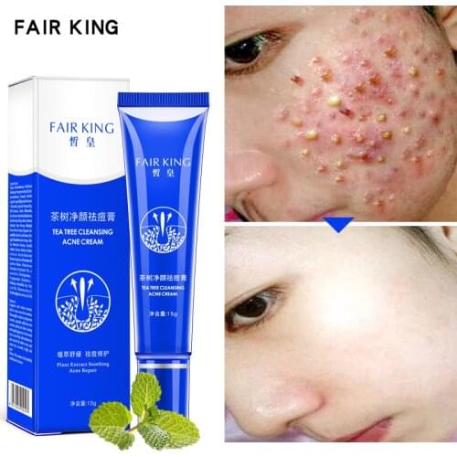 Hot 15ML Acne Treatment Blackhead Remova Anti Acne Cream Oil Control Shrink Pores Acne Scar Remove Face Care Whitening