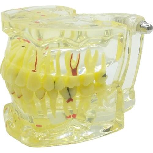 Dental materials denture model Oral unremovable dental pathological model Tooth Study Teach Model