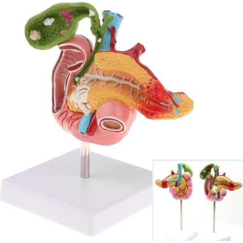 1:1 Real Human Size Pancreaticoduodenal Ulcer Pancreatic Cancer Campus Experimental Biological Teaching Simulation Model