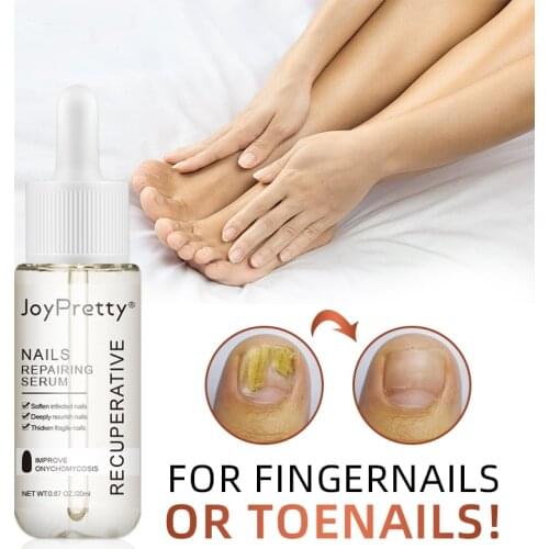 AuQuest Fungal Nail Treatment Serum Foot Repair Essence Care Nail Foot Whitening Toe Nail Fungus Removal Gel Anti Infection 20ml