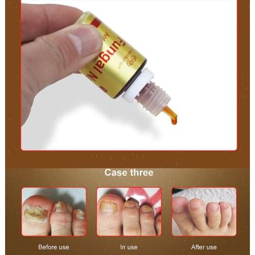 QINGFANGLI Nail Oils