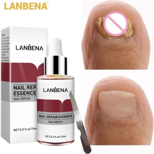 LANBENA Fungus Nail Serum Fungal Toe Nail Repair Essence Treatment Repair Onychomycosis Soften Brighten Hand Foot Nail Care 12ml