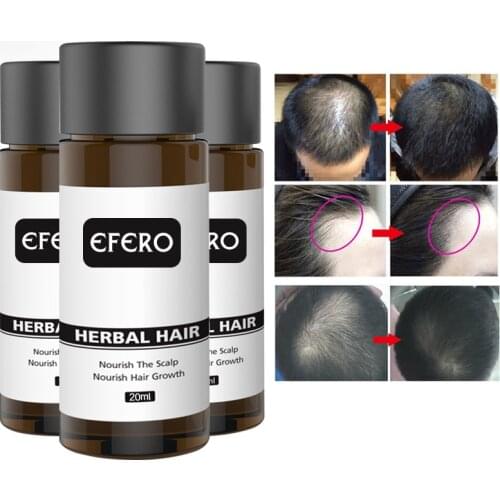 EFERO Hair Growth Essence Oil Hair Beard Growth Serum Anti-hair Loss Products Hairs Care Treatment Essential for Women Men 20ML
