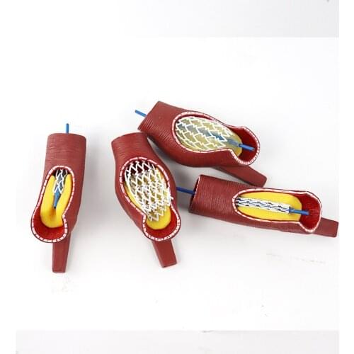 Blood vessel blocking stent enlargement model Cardiac stent Coronary artery stent model educational equipment