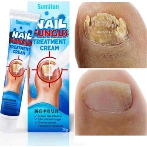 3/2PCS 20g Nail Fungal Treatments Cream Effective Anti-Fungal Nail Infections Onychomycosis Cure Creams Nail Fungus Removal Gel