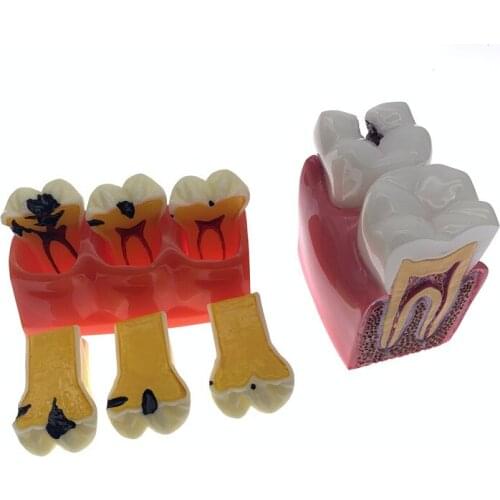 1 pc Dental Materials Lab 4 Times Caries Disassembling Model Denture Disease Teeth Model For Dentist Clinic