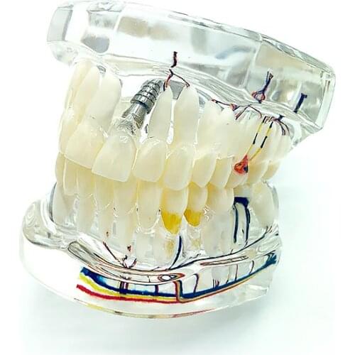 Dental Model Tooth Dentist Pathologies Repair Model with Nerve Teeth Teaching Model