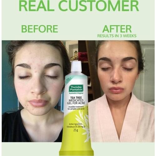 2021 Original Austrilia Thursday Tea Tree Medicated Acne Gel Kill Bacteria Anti Infection Acne Removal Cream 25g Latest Version