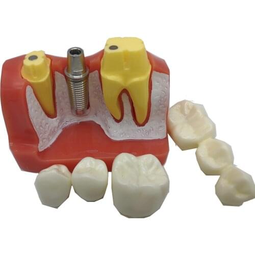 Dental Implant M2017 Teaching Teeth Model 4 Times Dental Resin Quartz Rubber Teeth Model Dentist Training Pathology Model