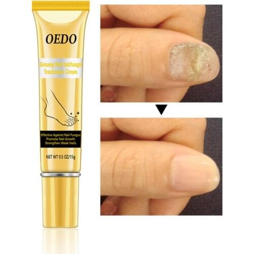 Ginseng Nail Antifungal Treatments Cream Accelerate Nails Growth Repair Nails Cream Improve Nails Tissue Anti Onychomycosis Gel
