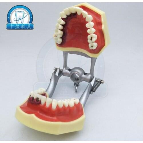 Dental teaching Periodontal pathology tooth model Practice dental calculus treatment