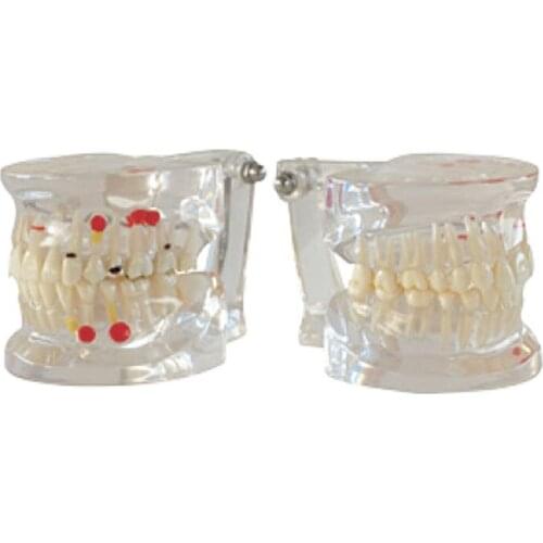 Dental Implant Disease Teeth Model With Restoration Bridge Tooth Dentist For Medical Science removable Disease Teaching Study