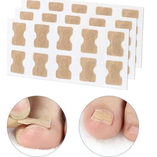 50 stickers Ingrown Toenail Paronychia Treatment Toe nail repair Nail Correction Stickers Pedicure Foot Toe Nail Straightening