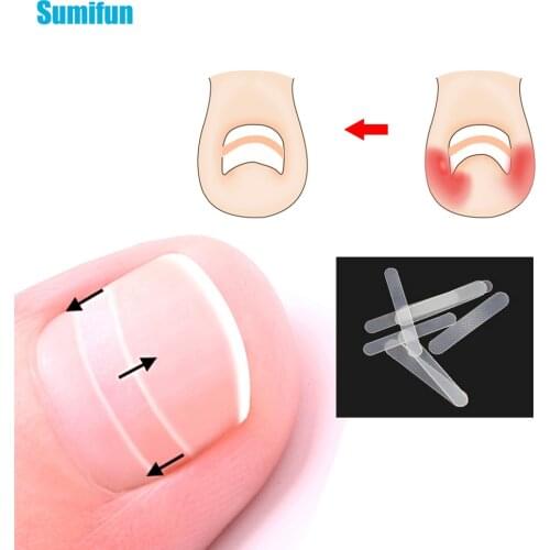 10pcs Toe Nail Ingrown Correction Sticker Foot Care Paronychia Orthopedic Patch File Elastic Patch Corrector Treatment C1510