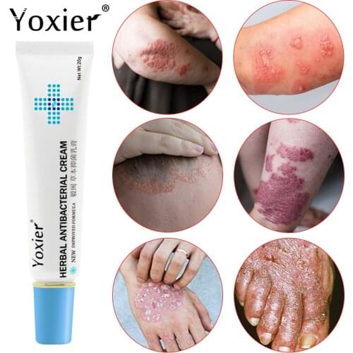 Herbal Eczema Psoriasis Cream Antibacterial Dermatitis Athletes Foot Relieve Itching Irritation Allergies Lithospermum Skin Care