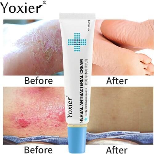 Herbal Eczema Psoriasis Cream Antibacterial Dermatitis Athletes Foot Relieve Itching Irritation Allergies Lithospermum Skin Care