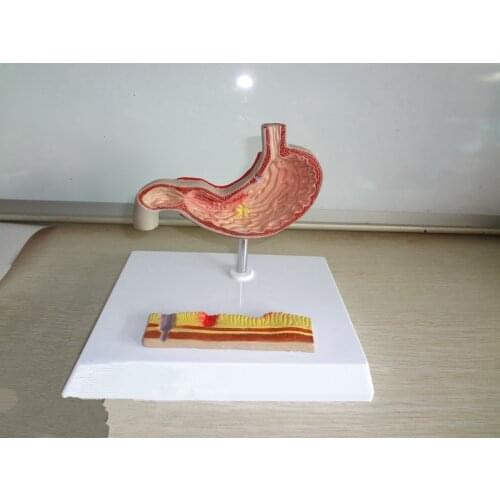 Gastric anatomy model Gastrointestinal Gastric ulcer model Digestive system