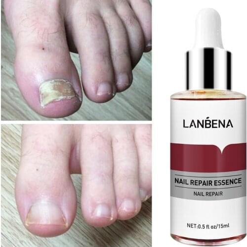LANBENA Nail Repair Essence Serum Anti Fungal Nail Treatment Remove Onychomycosis Nourishing Brighten Hand Foot Toes Nail Care