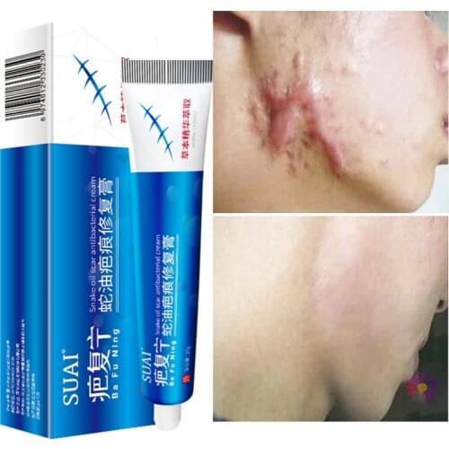 20g Acne Scar Removal Cream Pimples Stretch Marks Face Gel Remove Acne Smoothing Whitening Moisturizing Body Skin Care