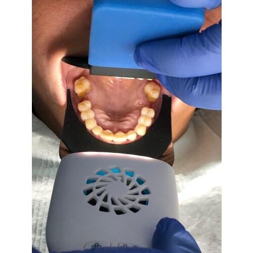 Orthodontic Oral Cavity Dental Oral Mirror Reflector with LED Light Dual Use Fog Free Photo Photography Occlusal Buccal Lingual