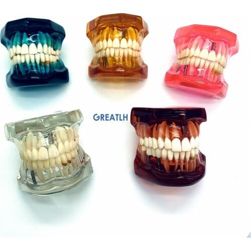 Dental Pathological Teeth Model teeth imPlant restoration model for dentist learning Teaching Study
