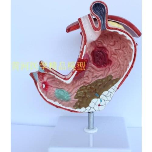 Human stomach anatomy model pathological stomach model gastric pathology