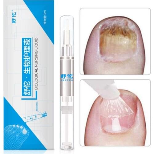 1Pc 3ML Fungal Nail Treatment Pen Onychomycosis Paronychia Anti Fungal Nail Infection Chinese Herbal Care Medicinal Liquid