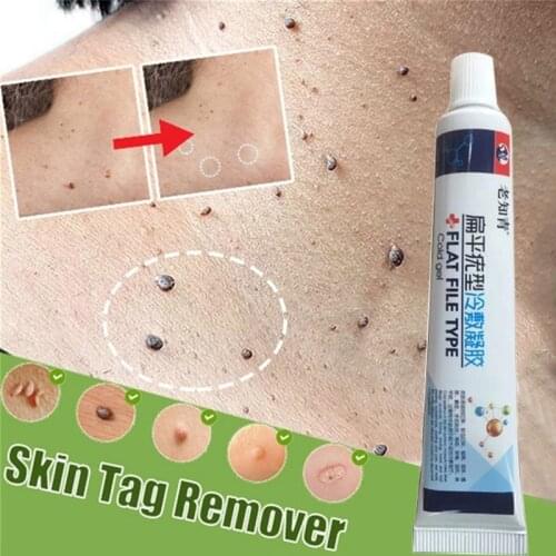 Skin Tag Remover Genital Wart Treatment Papillomas Removal of Warts Liquid From Skin Tags Removing Against Moles Remover