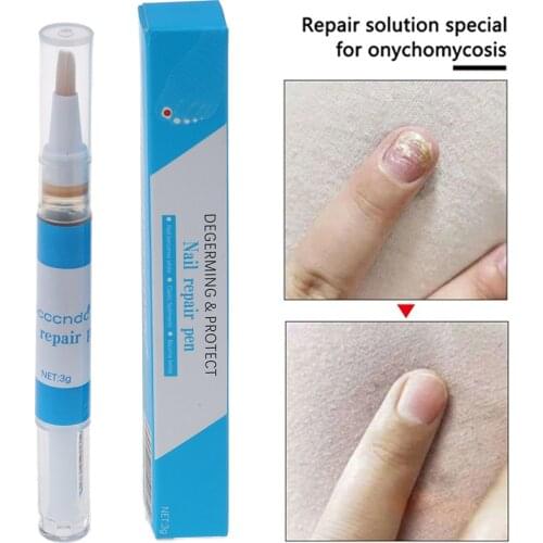 Toenail Fungus Treatment Pen Onychomycosis Paronychia Anti Fungal Chinese Herbal Toe Nail Fungus Treatment