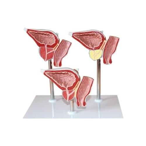 Prostate Pathological changes model Benign prostatic hyperplasia free shipping