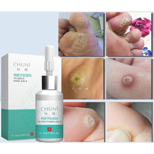 10ML Brucea Javanica film-forming agent corns hand and foot cocoon pricking biofilm