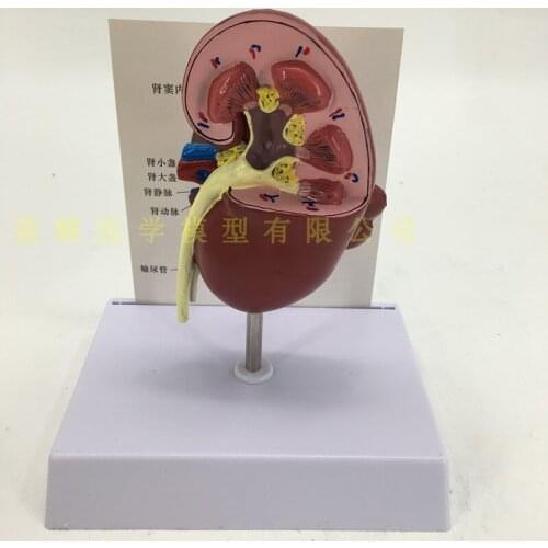 Kidney anatomical model diseased kidney internal organs anatomical model