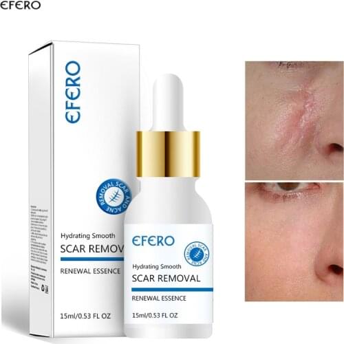 Scar Removal Essence Acne-Treatment Oil-Control Face Serum Hydrating Smooth Shrink Pore Repair Stretch Marks Nourish Skin Care