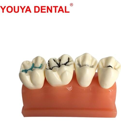 Dental Model Resin 4times Pit And Fissure Sealment Tooth Modeling For Studying Teaching Medical Science Oral Dentistry Products