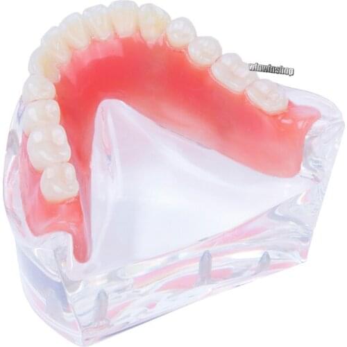 Dental Overdenture Teeth Model Removable Interior Mandibular with 2 Implant for Tooth Teaching Study