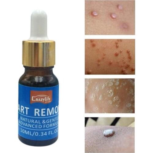 Feet Corn Remover Powerful Foot Fingers Callus Remover Skin Smooth Safe Treatment Liquid Warts Skin Body Care Rejuvenation W8W1