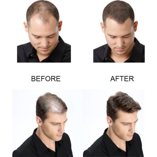 Fast Hair Growth Spray for Men Herbal Hair Growth Accelerator Hair Treatment 30ml WH998