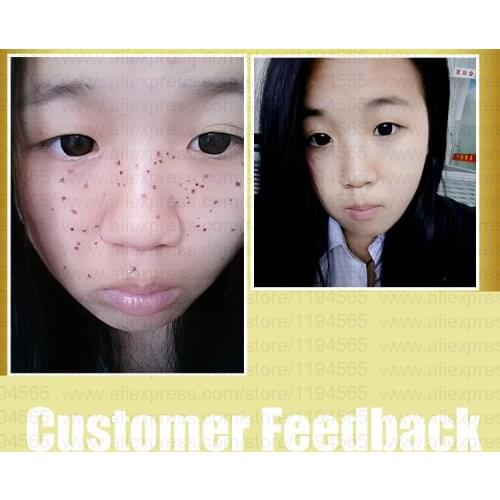 2pcs Set Speckles Moles Warts Removal Black Spots Splashes Remover Free Shipping