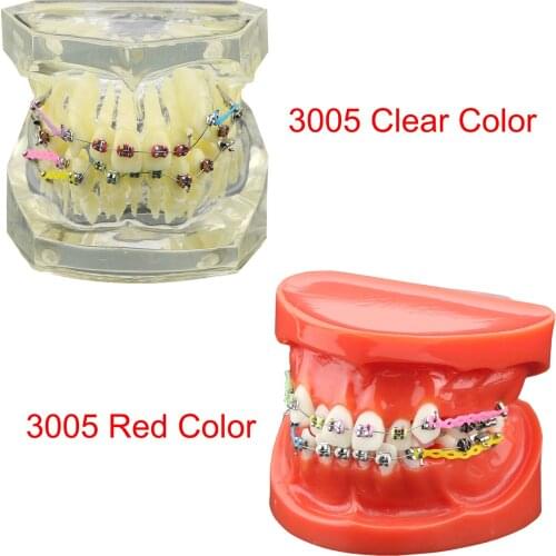 Dental Orthodontics Treatment Demonstration Model With Metal Brackets Arch Wires Ties Chains