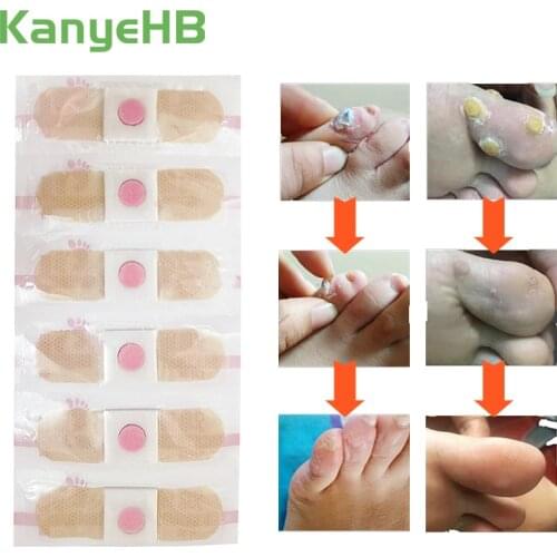 48pcs Detox Foot Corn Remover Patch Removal Foot Pads Warts Thorn Patches Feet Care Medical Pain Relieving Plaster A296