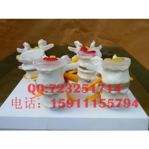 Free shipping Waist lumbar model lumbar disc disease pathology model human skeleton model