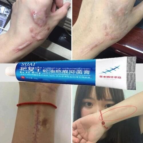 20g Acne Surgery Scar Repair Patch Acne Stretch Mark Care Gel Remove Body Smoothing Whitening Acne Moisturizing Skin To A4X7